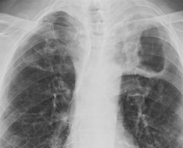 Tuberculosis_image1