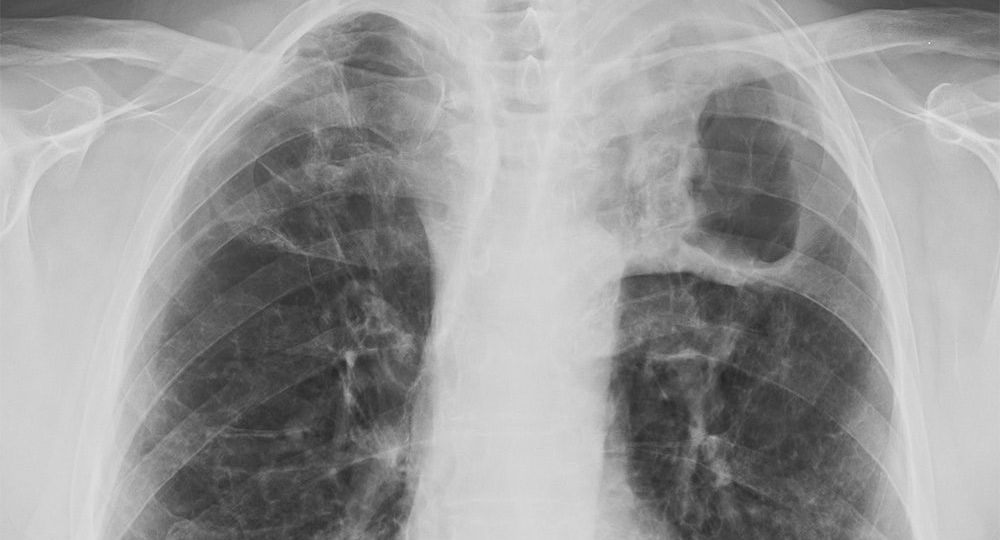 Tuberculosis_image1